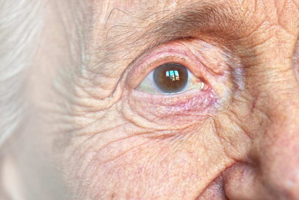 psiara alzheimer 02